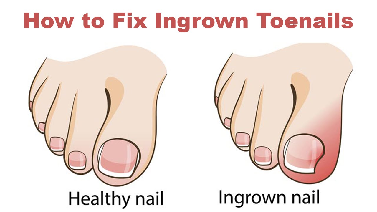 South Burnett Podiatry | Why Your Ingrown Toenails Keep Coming Back - And  How To Fix Them